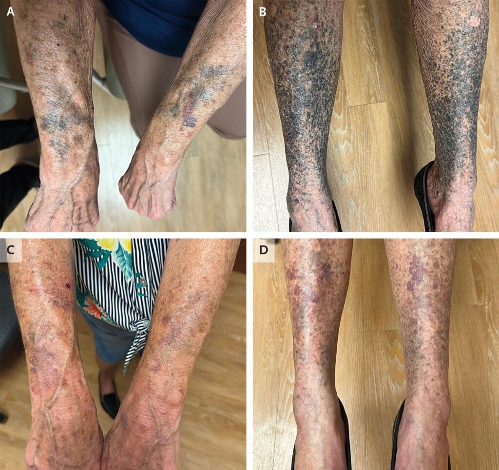 Efeitos Raros da Minociclina: Idosa dos EUA Apresenta Pele Azulada e Preta Após Uso de Antibiótico