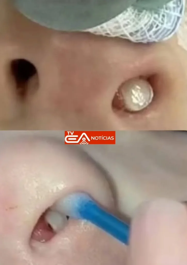 Surpreendente: Dente Surge Dentro do Nariz de Criança em Curitiba